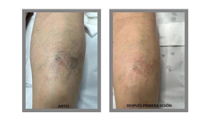 Imagen del antes y el después de la primera sesión de escleroterapia.