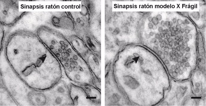 Sinapsis de un ratón control (izquierda) y sinapsis de un ratón modelo del síndrome del X Frágil (derecha). Se puede apreciar claramente que el ratón modelo del FXS presenta más vesículas sinápticas en contacto con la membrana presináptica.