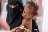 Foto: Cerca de 540.000 niños yemeníes menores de cinco años sufren desnutrición con riesgo de muerte