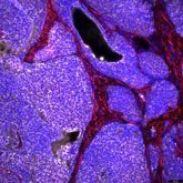 Foto: Buenos resultados de la terapia con células CAR-T contra el cáncer de mama, pulmón y cerebro