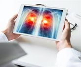 Foto: Identifican una nueva estrategia terapéutica potencial para tratar el cáncer de pulmón