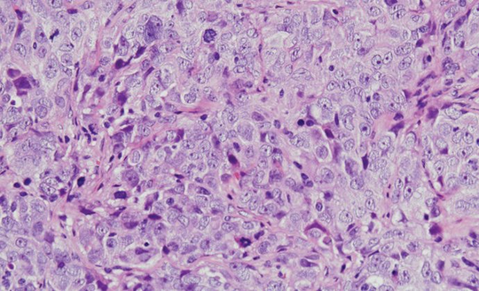 Cáncer de ovario seroso de alto grado