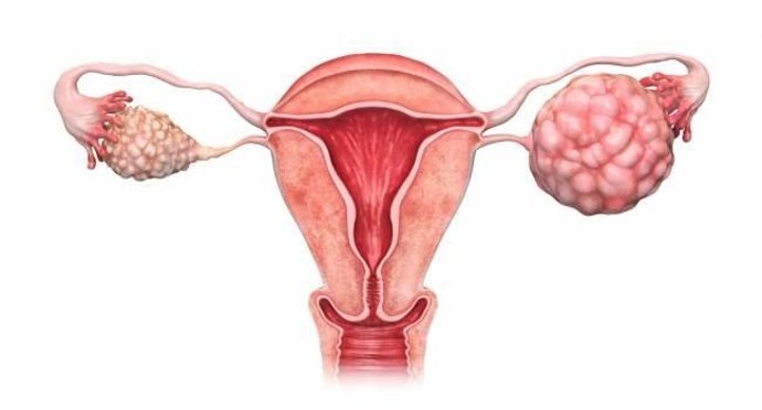 El cáncer de ovario supone el 2,9% de todos los tumores en mujeres en la Comunitat Valenciana