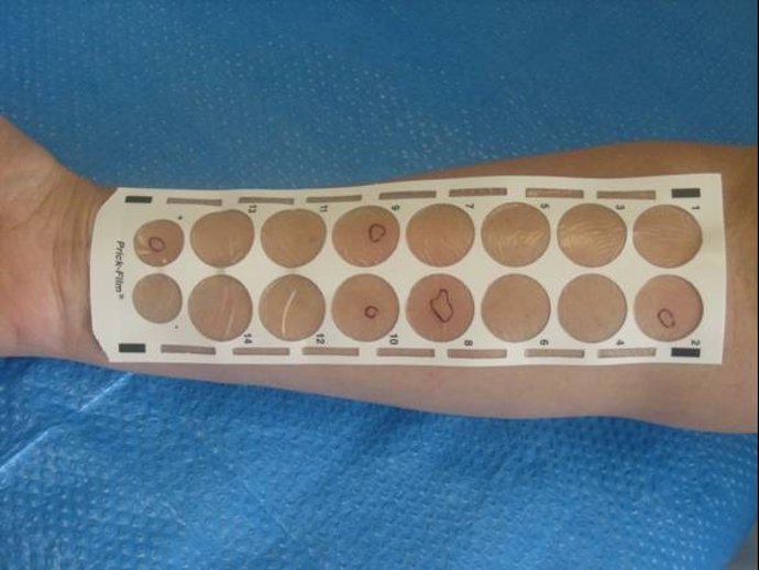 Archivo - Pruebas de alergia 