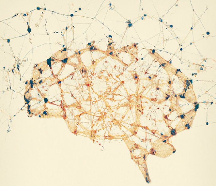 Archivo - Cerebro afectado por la esquizofrenia.