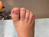 Foto: Dermatólogos aconsejan usar menos esmaltes y calzado que no transpira para evitar hongos en las uñas