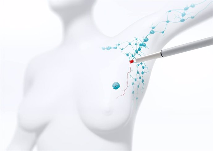 Archivo - Un estudio español demuestra la utilidad del marcaje ganglionar previo al tratamiento quimioterápico en cáncer de mama