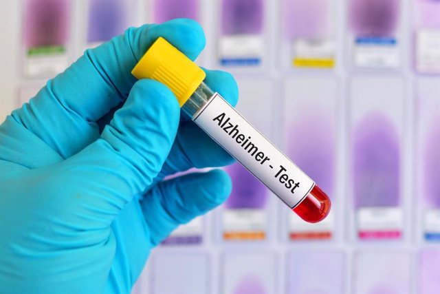 Archivo - Pureba del Alzheimer en sangre.