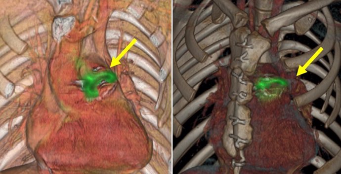 Endocartitis valvular pulmonar