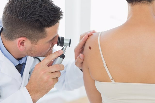 Archivo - Melanoma, dermatólogo