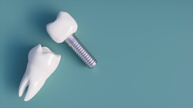 Archivo - Implante dental