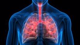 Foto: Los pacientes de cáncer de pulmón podrían suspender la inmunoterapia después de dos años