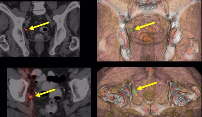 Foto cabecera recidiva ganglionar del cáncer de próstata.