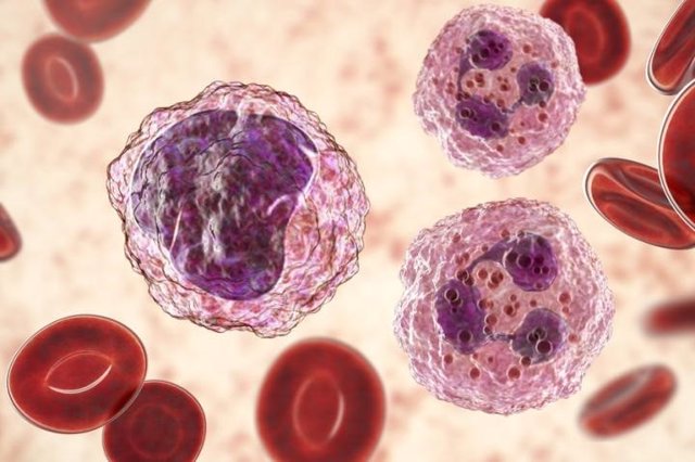 Archivo - Cambios notables en el número y la proporción entre los diferentes tipos de células sanguíneas es un signo de leucemia.