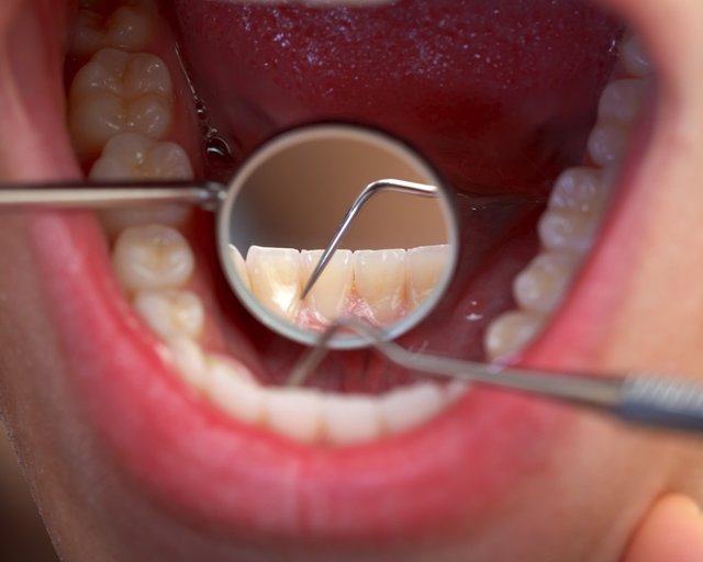 Archivo - Dentista, dientes, sarro