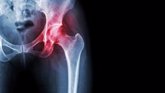Foto: Traumatólogo llama a la prevención de las fracturas de cadera en los mayores mediante revisiones óseas y de la dieta