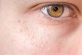 Foto: Qué son los quistes de millium o esas antiestéticas bolitas blancas que puede aparecernos en el ojo o en la cara