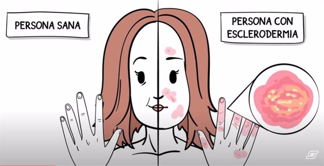 Archivo - Pacientes con esclerodermia y reumatólogos abogan por mejorar el diagnóstico precoz y la accesibilidad a tratamientos