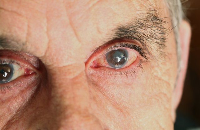 Archivo - Uveitis, ojos rojos, dolor de ojos