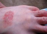Foto: Un "mal cuidado" de la piel puede derivar en patologías como el eczema