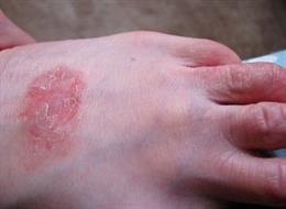 Archivo - Eczema piel
