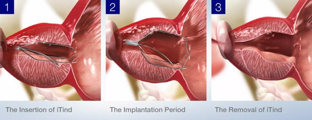 The iTind procedure involves the placement of a temporarily implanted nitinol device that reshapes the prostatic urethra without burning or cutting out the prostate. The device remains in place for five to seven days, and upon removal, patients experienc