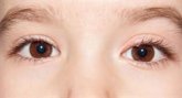 Foto: Los orzuelos en edad infantil pueden ser un signo de defectos refractivos no diagnosticados, según una experta