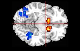 Archivo - Áreas Afectadas Del Cerebro En Personas Con Psicosis