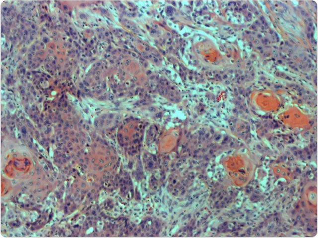 Archivo - Corte transversal de un tumor carcinoma de células escamosas de cabeza y cuello de un paciente con anemia de Fanconi.