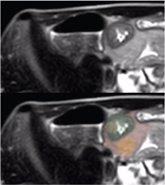Foto: La radiómica mejora la precisión del diagnóstico de la enfermedad de Crohn en comparación con radiólogos expertos