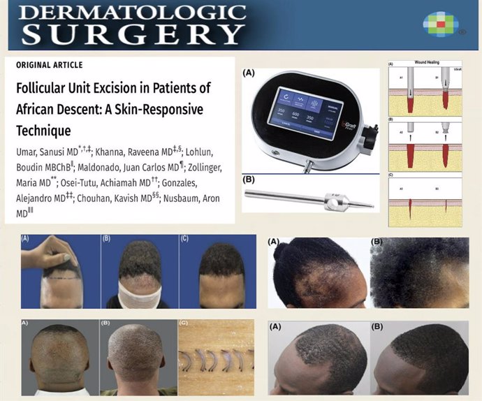 New skin-responsive FUE device marks a significant step towards providing an effective hair restoration solution to individuals of African descent.