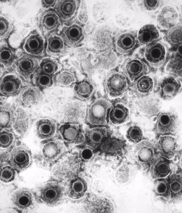 Archivo - Herpes Simple Virus