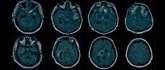 Foto: Un estudio identifica las lesiones cerebrales que pueden estar detrás de la conciencia oculta