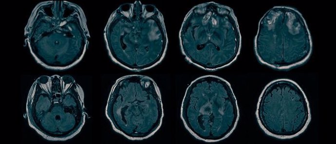 Archivo - Las resonancias magnéticas revelan lesiones cerebrales subyacentes a la conciencia oculta.