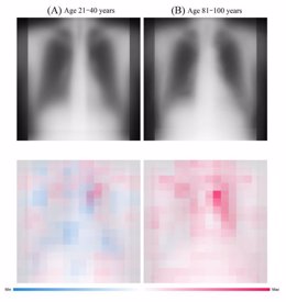 Las imágenes superiores son las radiografías de tórax de pacientes de 21 a 40 años y de 81 a 100 años cronológicamente y las imágenes inferiores son una visualización del foco de la IA (ambas después de promediar).