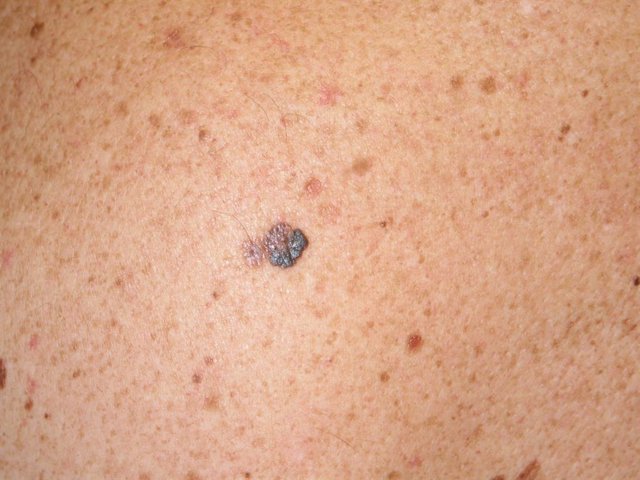 Archivo - Melanoma