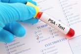 Foto: Los niveles de PSA tras el tratamiento pueden no ser un indicador fiable de la supervivencia en cáncer de próstata