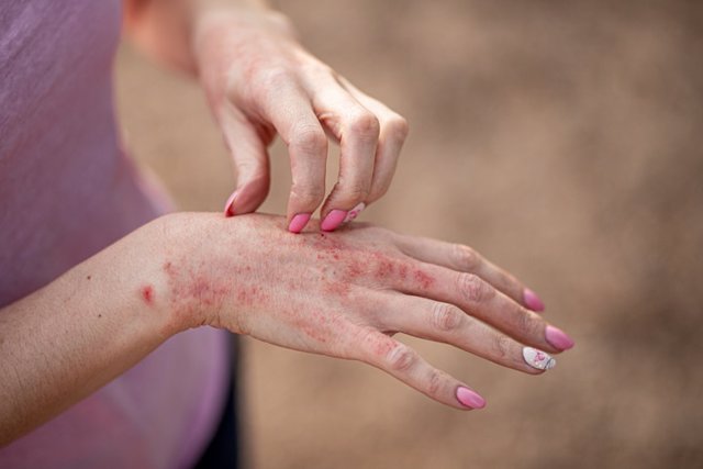 Archivo - Eczema dermatitis