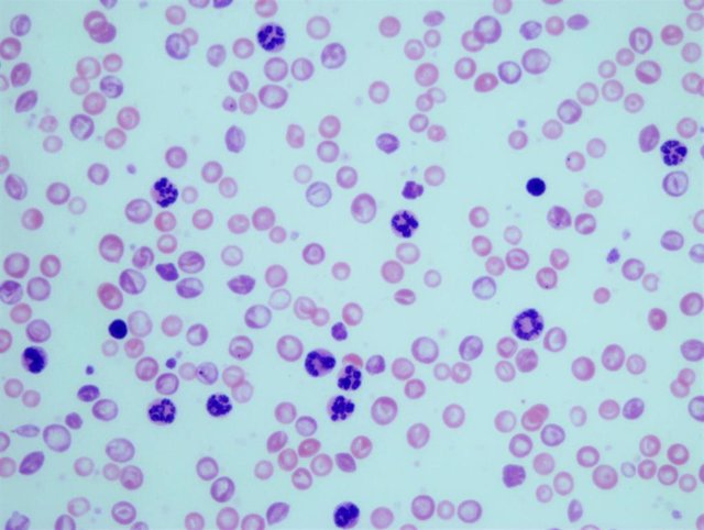 Archivo - Granulocitos en muestras sanguíneas de ratones con leucemia mielogénica crónica.