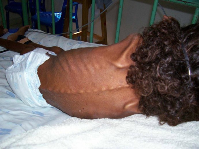 FOTO # 41 (HORIZONTAL) FO5041  Este sábado se confirmó la muerte de una menor de 16 años en La Guajira, quien padecía de tuberculosis y gastritis asociada a un cuadro severo de desnutrición.