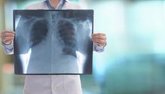 Foto: Un nuevo estudio asocia las infecciones fúngicas a la agresividad del adenocarcinoma de pulmón