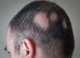 Foto: Lilly anuncia la aprobación en España de 'Olumiant', el primer tratamiento para la alopecia areata grave