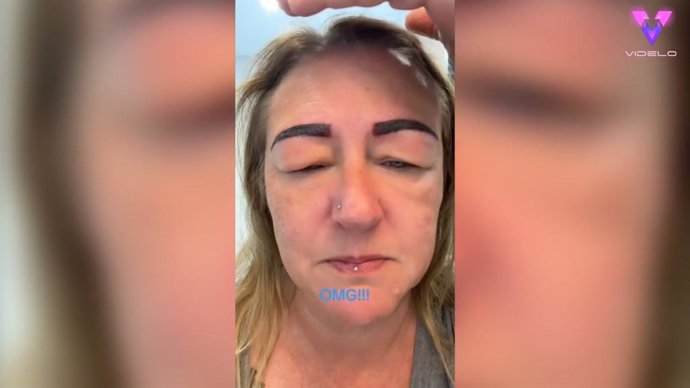 Un procedimiento estético de cejas sale terriblemente mal con antibióticos y antihistamínicos para rebajar el hinchazón del rostro