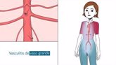 Foto: ¿Cuáles son los síntomas de la arteritis de Takayasu?
