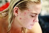 Foto: Así afecta emocionalmente a las mujeres el acné en la edad adulta