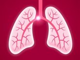 Foto: Conoce mejor las embolias pulmonares, en muchos casos sin síntomas y con un mal pronóstico