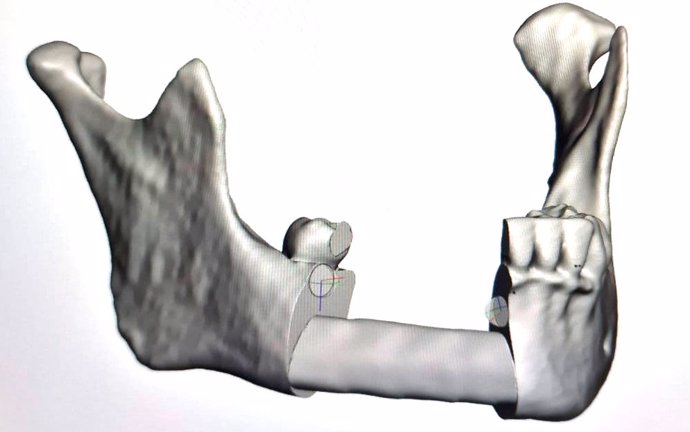 Tras un tumor poco frecuente de los maxilares, expertos recomiendan la econstrucción mandibular mediante el hueso perone