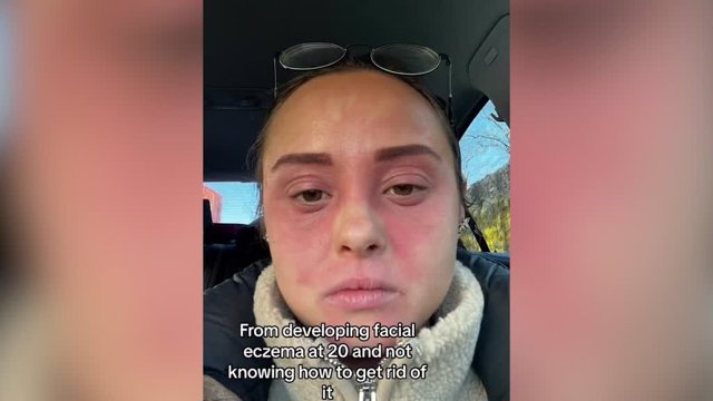 Una joven ha revelado la increíble transformación de su piel tras curar un eccema facial tan grave que la llevó al hospital.