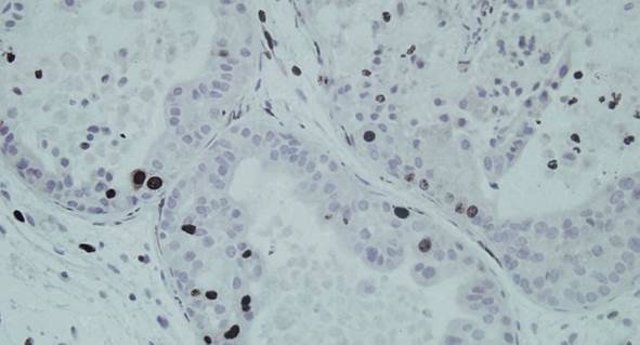 Tumores de próstata de modelos murinos preclínicos en los que se ha eliminado el gen Mettl1.