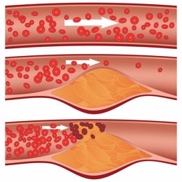 Archivo - Niveles de colesterol en la sangre